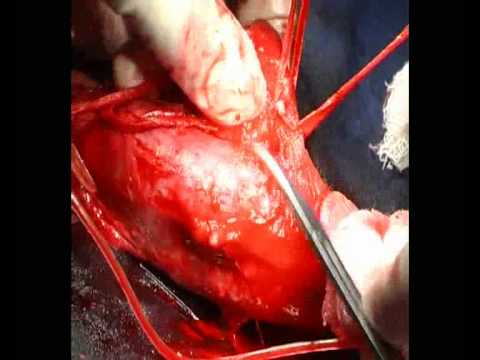 Krishnamurti Operation for Peyronie\'s Disease