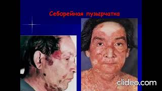 Вирусные и везикулярные заболевания кожи и слизистых оболочек полости рта