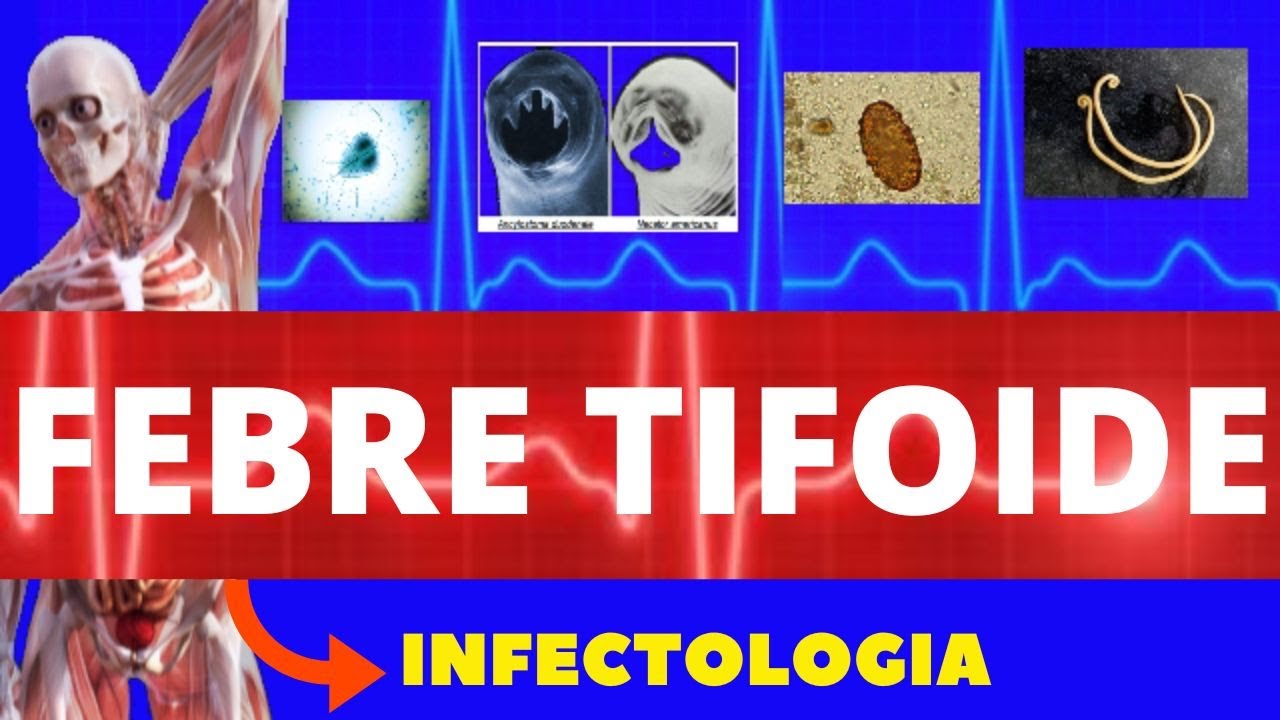 FEBRE TIFOIDE - CARACTERÍSTICAS, SINTOMAS, DIAGNÓSTICO E TRATAMENTO - INFECTOLOGIA