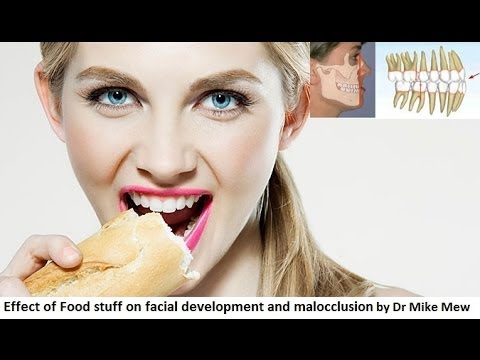 Effect of Food Stuff on Facial Development and Malocclusion by Dr Mike Mew