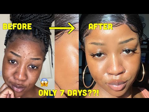 HOW I CLEARED MY SKIN in 1 WEEK!!!! and LIGHTENED my...