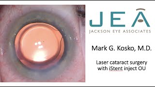 Download Lagu laser cataract surgery istent inject OU Kosko Thumbnail