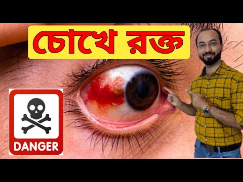 চোখে রক্ত জমে যাবার কারণ | চোখে রক্ত জমলে করণীয় | Blood Clot In Eyes | Sub Conjunctival Hemorrhage