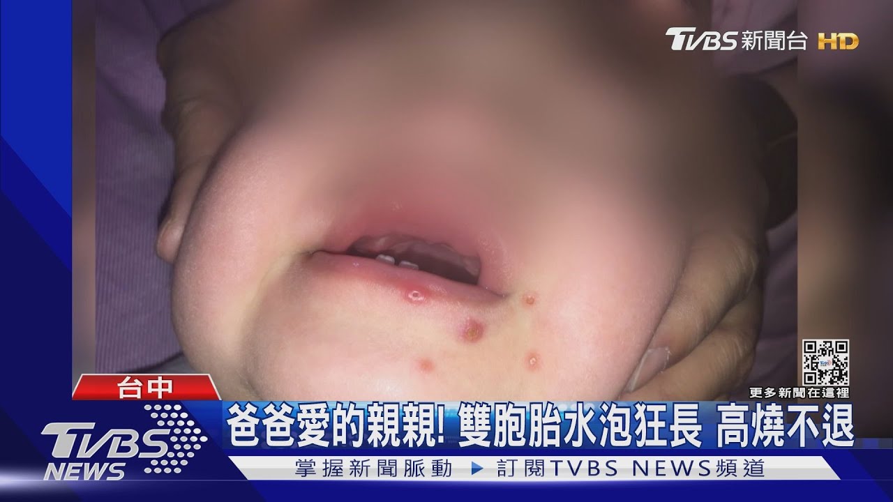 爸爸愛的親親！雙胞胎水泡狂長　高燒不退