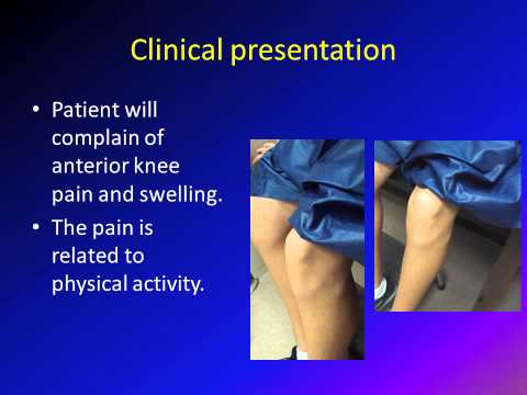 Osgood Schlatter disease