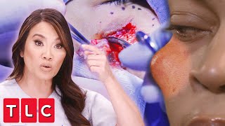 Massive Cyst Removal: Dr. Lee Excises a Giant Bump on Che&#39;re&#39;s Face | Dr. Pimple Popper