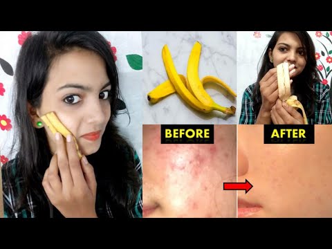 NO MORE ACNE & PIMPLES! USE BANANA PEEL ON SKIN FOR 1 WEEK AND GET 100% RESULT//BANANA PEEL FOR FACE