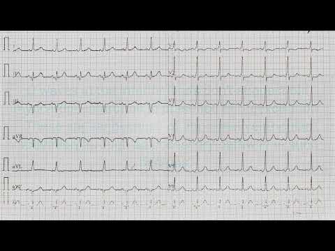 ECG Quiz 20 @LearningCardiology