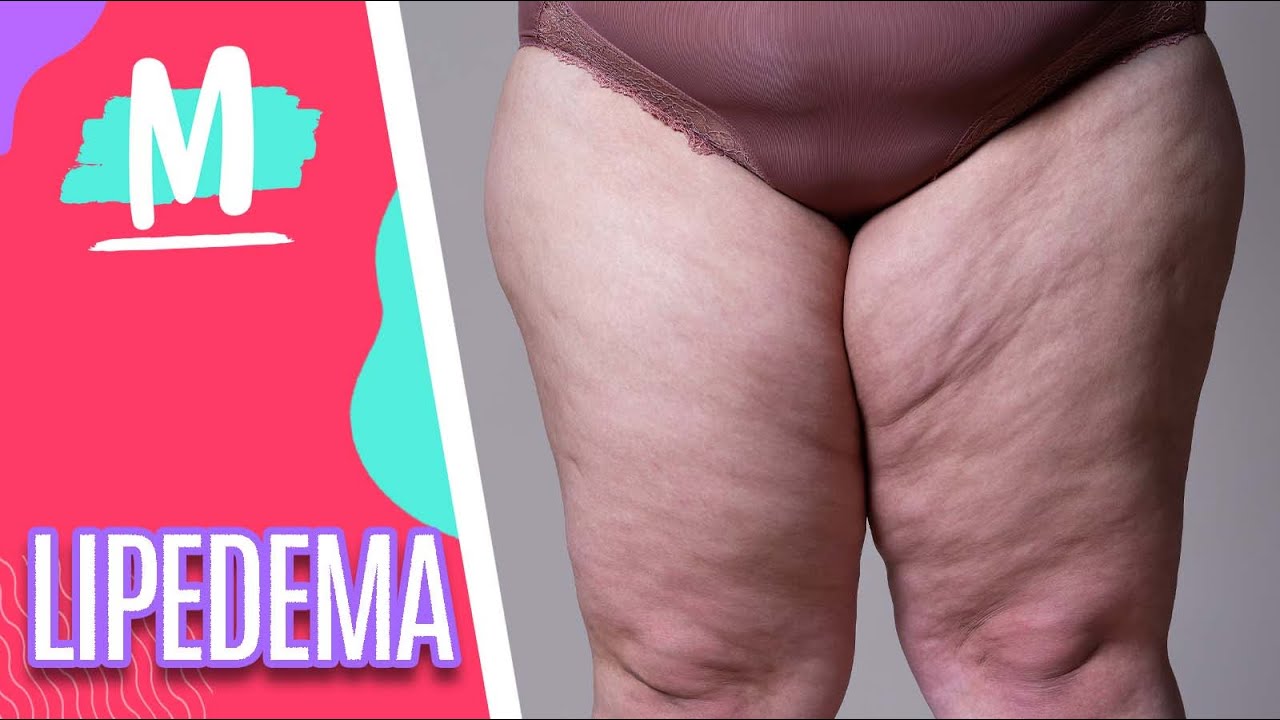 LIPEDEMA: conheça mitos e verdades - Mulheres (29/11/22)
