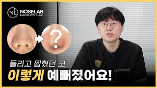 구축코 수술 후, 코가 이렇게 변했다고? (실제 사례 분석)