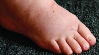 how to get rid of water retention in feet and ankles