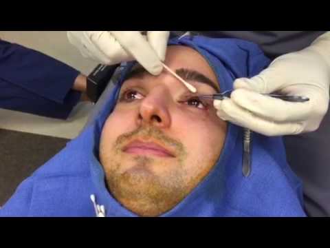 Eyelid Ptosis – Droopy Eyelid Surgery – Hidden Incision Eyelid Ptosis – Droopy Eyelid Surgery – Hidden Incision