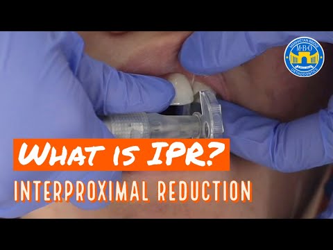 Interproximal Reduction (IPR) on Teeth for Braces and Invisalign
