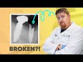 Can Dental Implants Really Break?! (You Need to Know This)