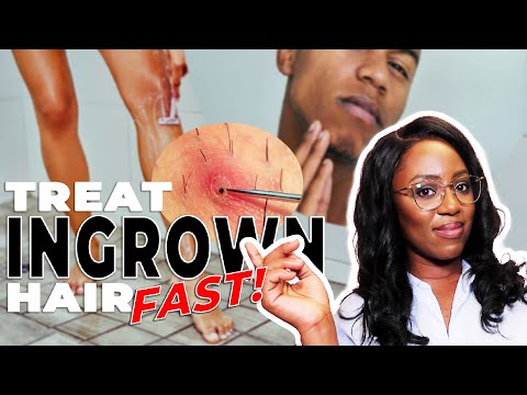 How to Remove Ingrown Hairs and Razor Bumps - This ACTUALLY works!