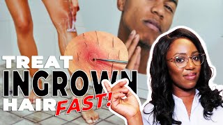 How to Remove Ingrown Hairs and Razor Bumps - This ACTUALLY works!