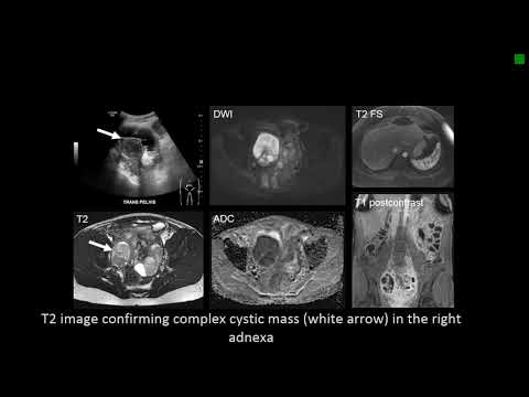 Pelvic Inflammatory Disease
