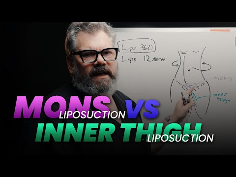 Enhancing Lipo 360: Mons Liposuction vs Inner Thigh Lipo