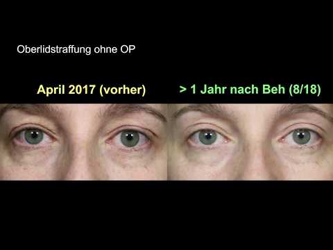 Augenlidstraffung ohne OP - Vorher Nachher Vergleich über 1 Jahr nach der Behandlung