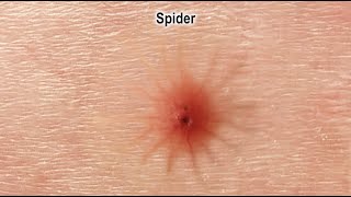 What Different Insect Bites Look Like