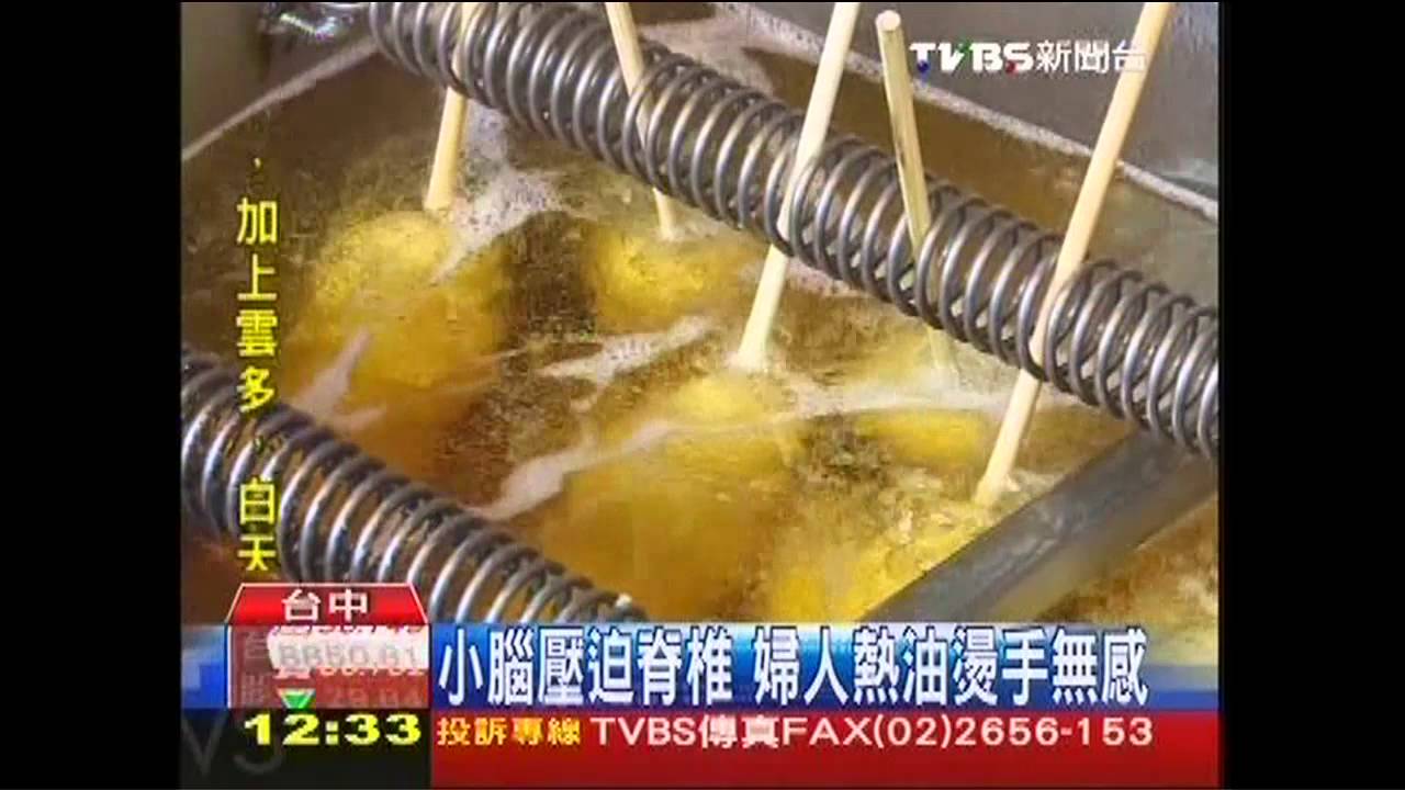 小腦壓迫脊椎 婦人熱油燙手無感