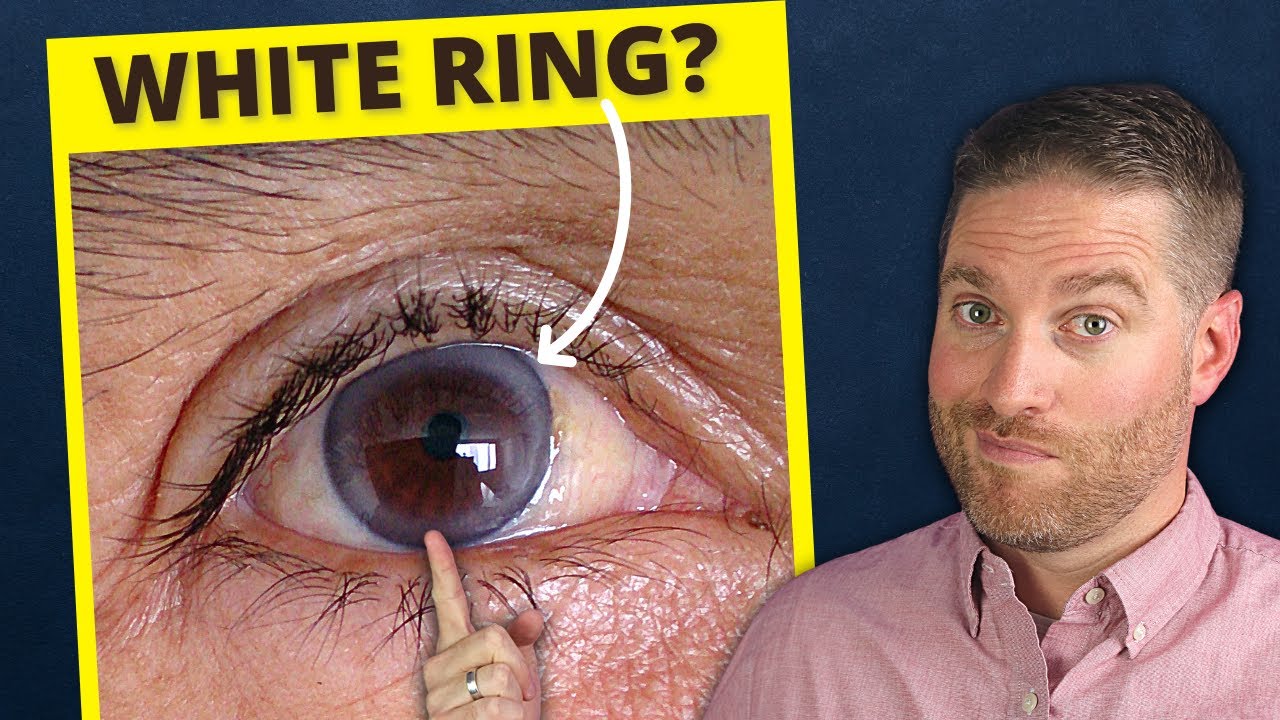 How do I get rid of the white ring around my iris? Tipseri