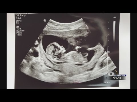 Aiken County Paramedics and EMT's revive pregnant woman, save unborn baby's life