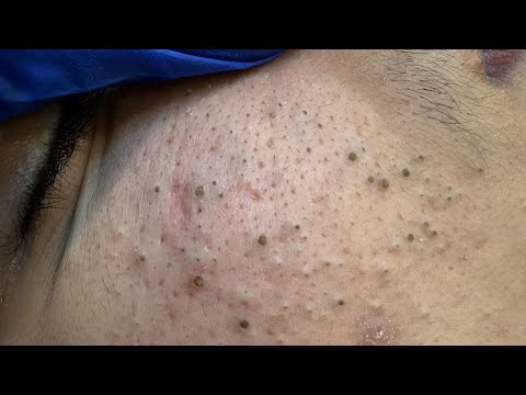 Deep Cleansing Techniques for Glowing Skin | Pimple & Blackhead Removal