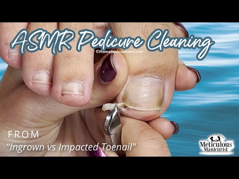 👣ASMR Pedicure Cleaning💆‍♀️Ingrown vs Impacted Toenail👣