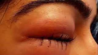 Download lagu Tips Mengobati Mata Bengkak Secara Alami dan Ampuh mp3 Download lagu Tips Mengobati Mata Bengkak Secara Alami dan Ampuh mp3