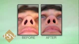 Plastic Surgery Bevely Hills | Rhinoplasty and Septoplasty