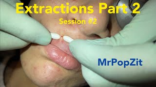 Extractions take 2, Session #2. Blackheads around lips and cheeks removed. Mining Pore dirt.