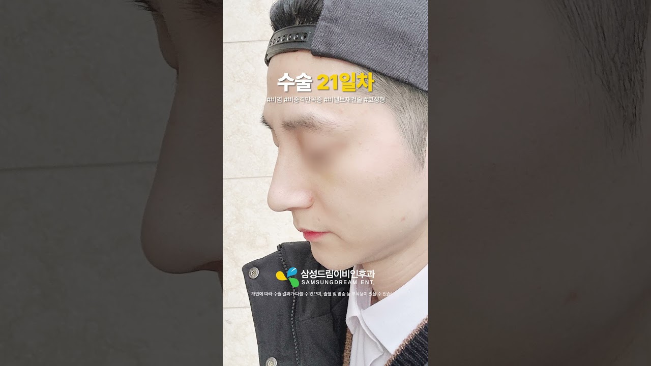 남자 비밸브 기능코성형 한달 후기🤞 #shorts  #비염수술 #비중격만곡증수술 #무보형물 #코성형 #남자코성형 #코성형브이로그 #코성형후기 #코성형전후 #비염 #비중격