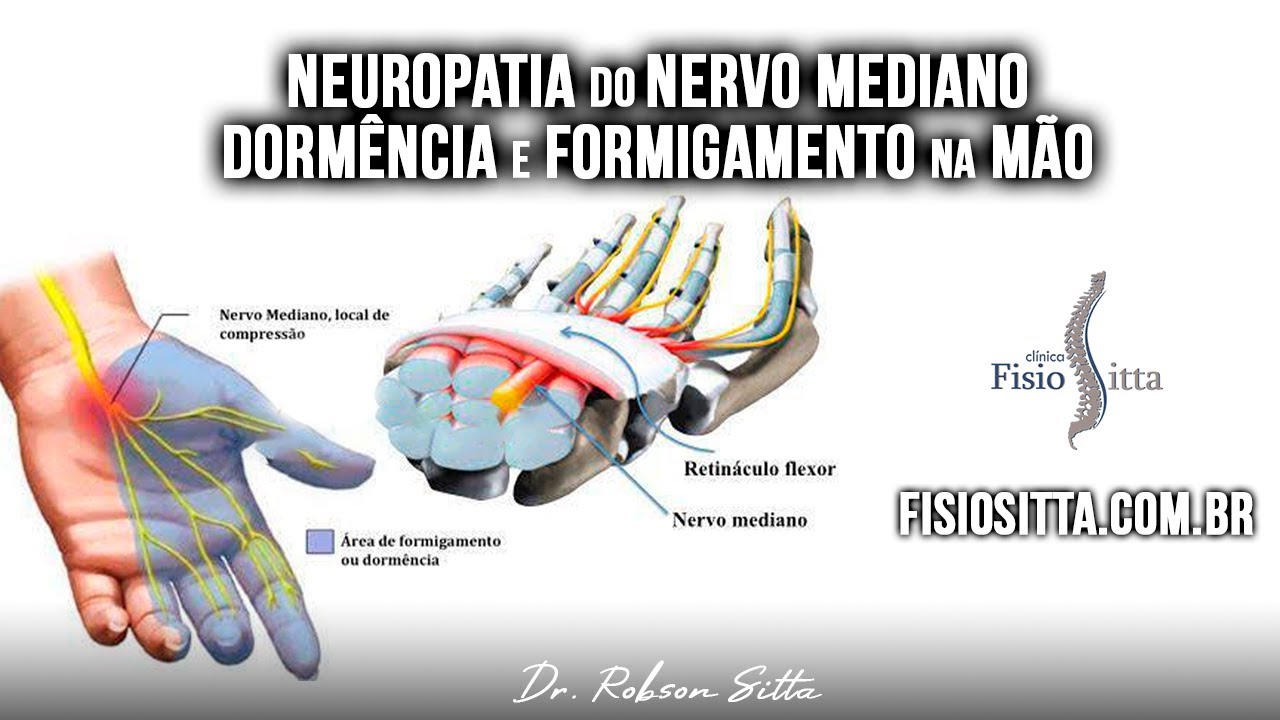 SÍNDROME do TÚNEL do CARPO COMPRESSÃO do NERVO MEDIANO - Clínica de Fisioterapia Dr. Robson Sitta