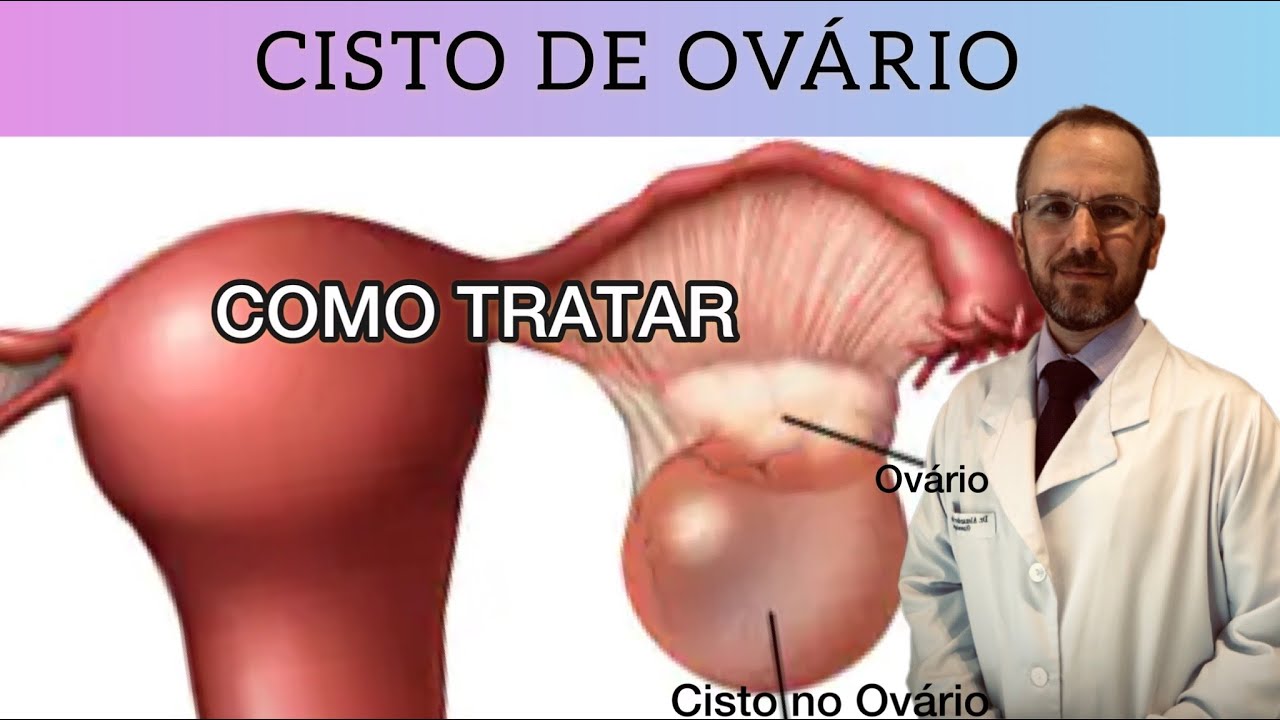 TUDO SOBRE O CISTO NO OVÁRIO