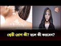 শ্বেতী রোগ নিয়ে জানুন Channel 24