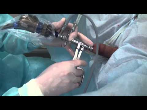 Цистолитотрипсия камни мочевого пузыря Cystolithotripsy bladder stones