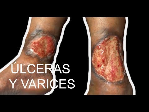 Leczema provocato da un fungo di fotografia Dieta a dermatite atopic nel tavolo