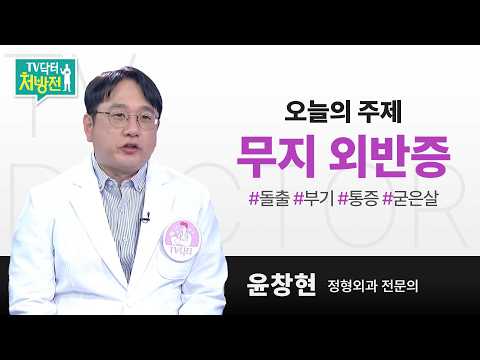 [TV닥터처방전] 무지외반증