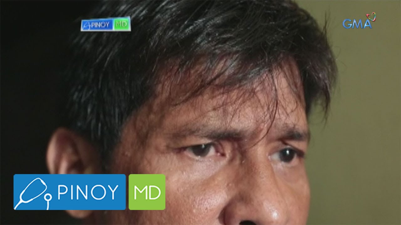 Putar video Pinoy MD: What is brain aneurysm sekarang Pinoy MD: What is brain aneurysm