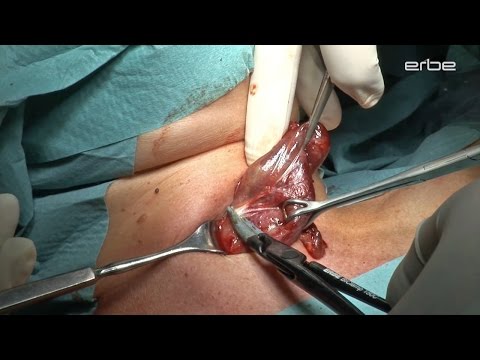 Hypertensive in Ägypten Blut Kind im Alter von 9 Druck sollte sein