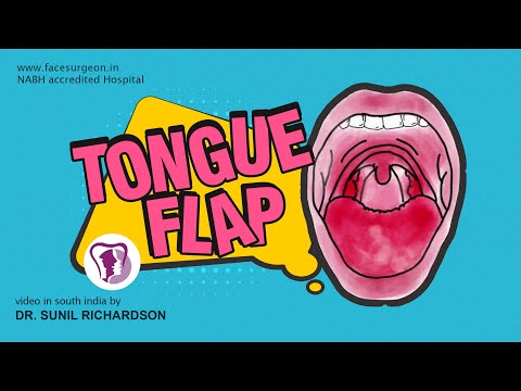 Tongue Flap For A Large Palatal Defect Reconstruction
