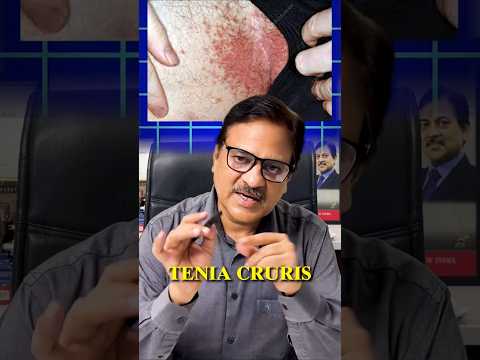 Fungal Infection prevention and treatment tips. #skincare #fungalinfection