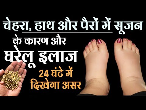 चेहरा, हाथ और पैरों में सूजन के कारण और घरेलू इलाज | 24 घंटे में दिखेगा असर