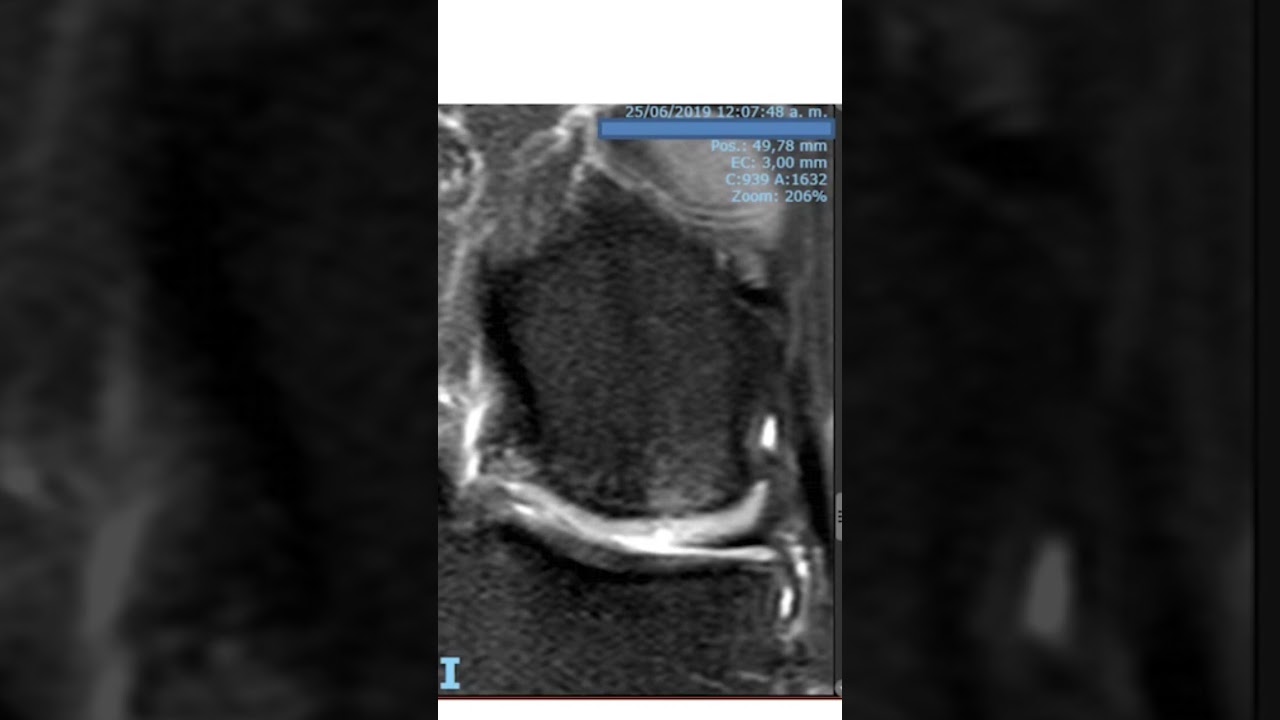 Resonancia Magnéticas de lesión de rodilla por osteoartrosis