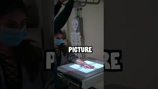 I BROKE MY WRIST #shorts