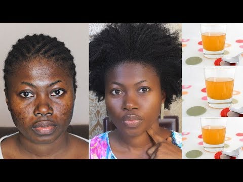YOU WILL NEVER HAVE SPOTS AGAIN IF YOU APPLY THIS MIXTURE ON YOUR FACE EVERYDAY