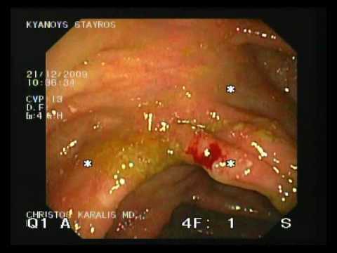 Zwężenie Zastawki Krętniczo-Kątniczej W Przebiegu Choroby Leśniowskeigo-Crohna