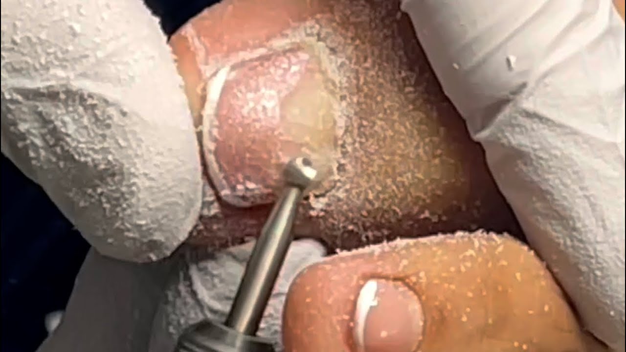 MIRA LO QUE HABÍA DEBAJO DE LA UÑA 😱 GRAN CAMBIO