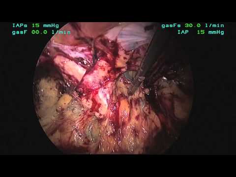Totally Extra-Peritoneal Laparoscopic Repair Of A Femoral Hernia